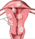 fibroid2
