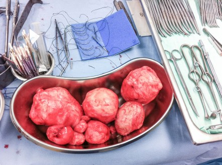 fibroid3