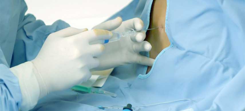 epidural-anaesthesia