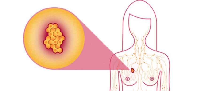 kanser-payudara
