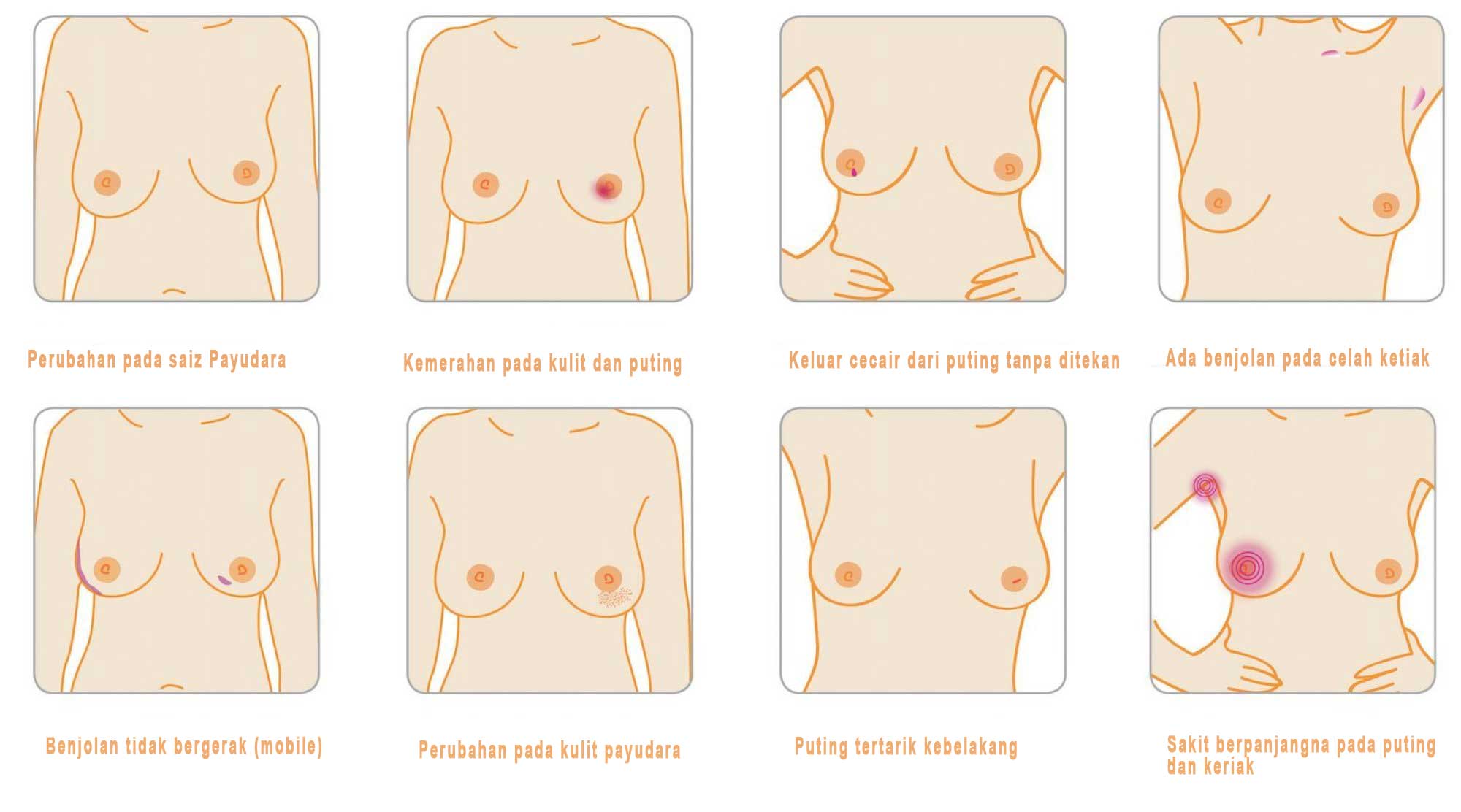 gejala-kanser-payudara