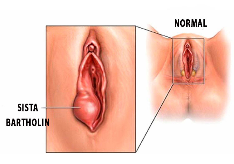sista-bartholin