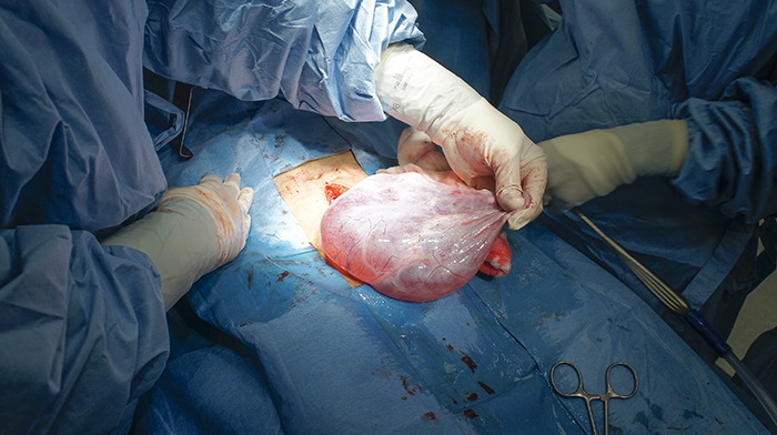 Adakah Terdapat Kaitan Antara Sista Ovari (Ovarian Cyst) dan&nbsp;Ketidaksuburan?