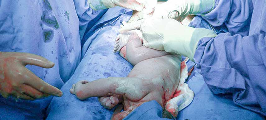 caesarean-2.jpg
