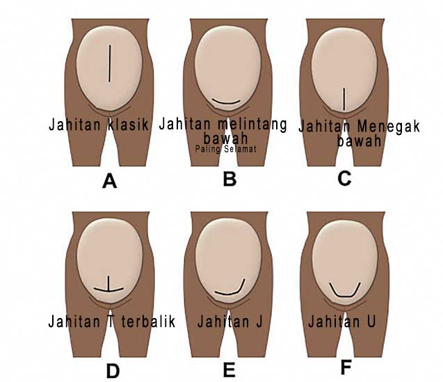 Jahitan-c-section.jpg
