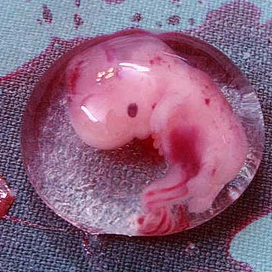 Beza Kandungan Hidup Dan Gugur Pada Usia 8&nbsp;Minggu