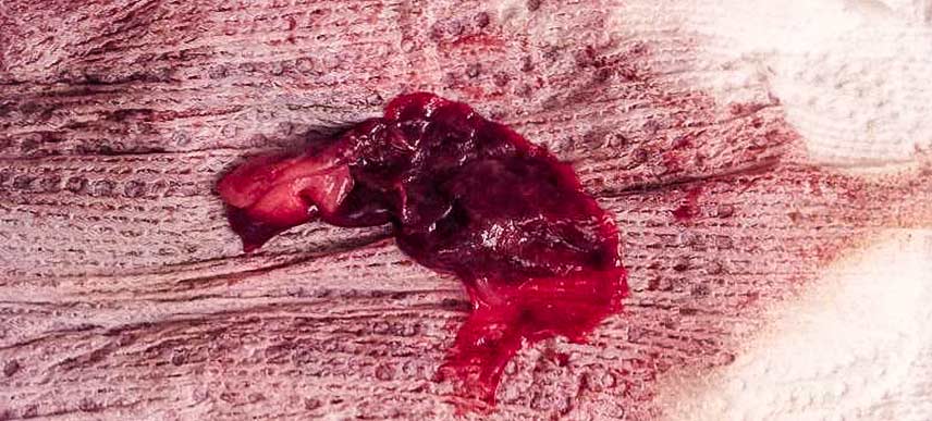 Apabila Haid Anda Masih Tidak Datang Selepas&nbsp;keguguran