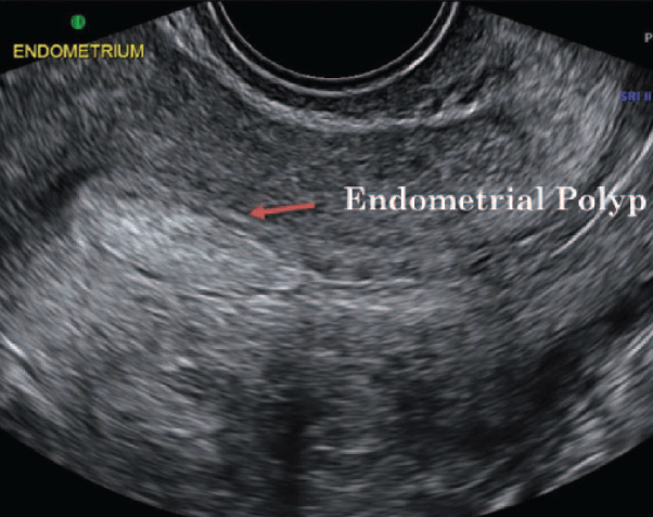 Endometrial Polip
