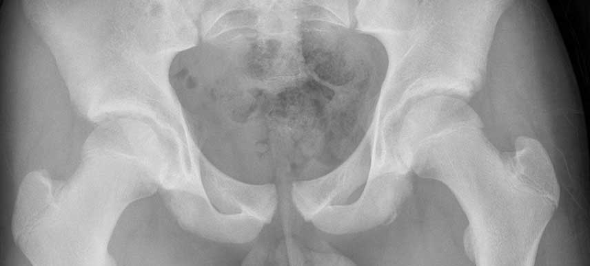 Symphysis-Pubis-Diastasis