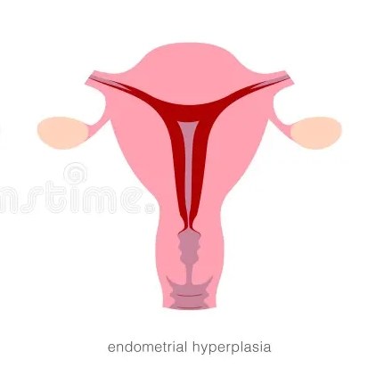 Hiperplasia Endometrium