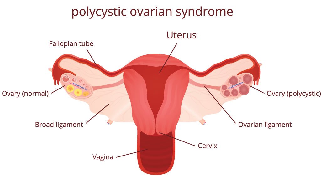 Ultrasound: PCOS