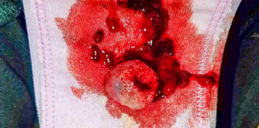 Ketahui 6 Punca&nbsp;Senggugut